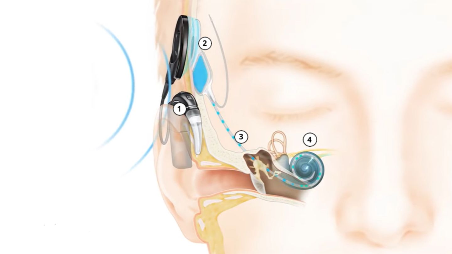 Cómo funcionan los implantes cocleares